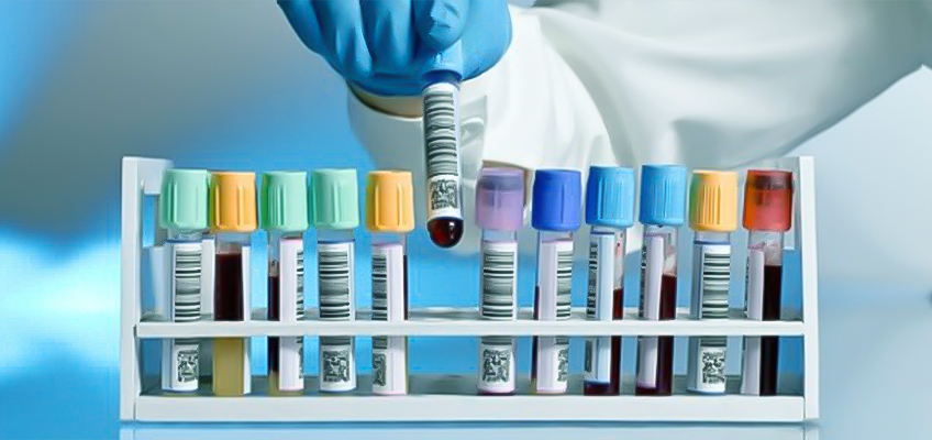 CHeBA Blog - Blood Test for Alzheimer’s: Close Or Hype?