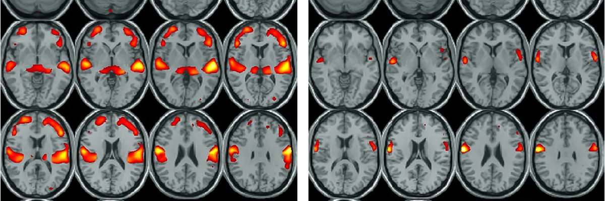 CHeBA Research Project: Grey Matter Volume Changes in Normal Ageing and MCI