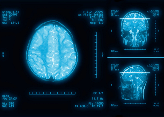 New Imaging Measure to Track Brain Ageing