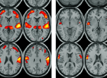 CHeBA Research Project: Grey Matter Volume Changes in Normal Ageing and MCI