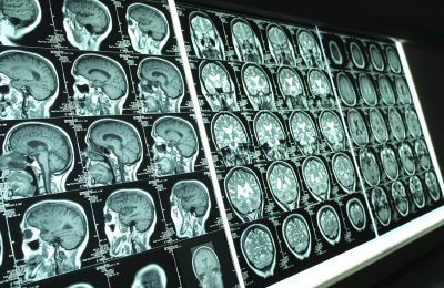 Fully Automated Software to Detect White Matter Lesions